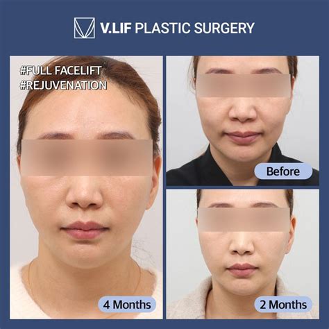 lv plastic surgery korea|vlif plastic surgery korea.